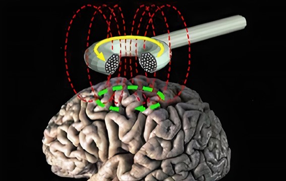 Estimulación transcraneal por corriente directa