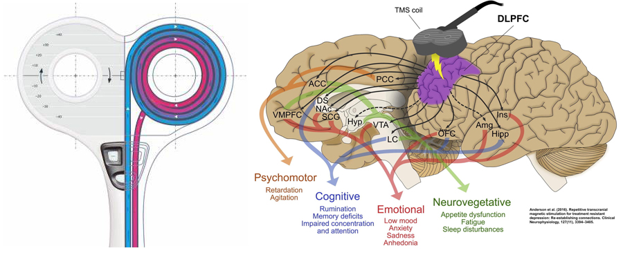 Estimulación Magenética Transcraneal