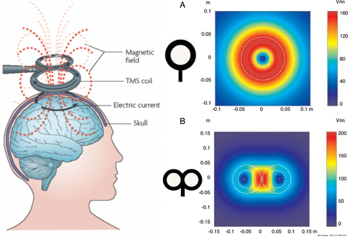 Estimulación Magenética Transcraneal